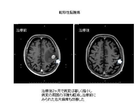 写真：転移性脳腫瘍、治療前、治療後、治療後2カ月で病変は著しく縮小し病変の周囲の浮腫も軽減し治療前にみられた右片麻痺も改善した