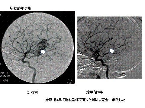 写真：脳動静脈奇形、治療前、治療後3年、治療後3年で脳動静脈奇形は完全に消失