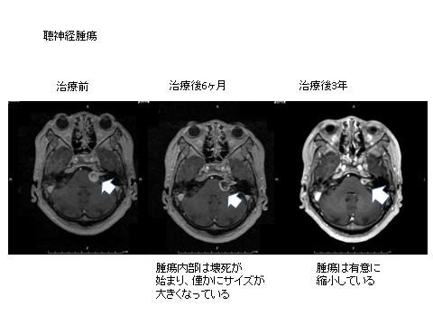 写真：聴神経腫瘍、治療前、治療後6カ月、治療後3年、6カ月で腫瘍の壊死が始まり、3年で腫瘍が縮小