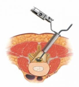 イラスト：腰部脊柱管狭窄症に対する低侵襲手術