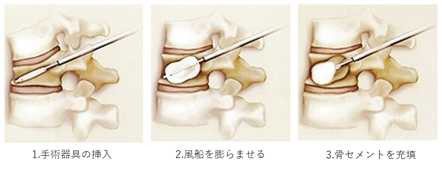 イラスト1：BKP治療法の手順