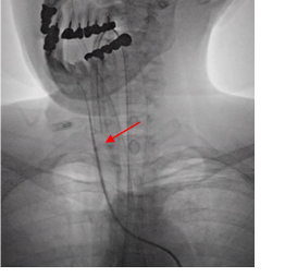 写真：大腿動脈から挿入されたカテーテルの様子