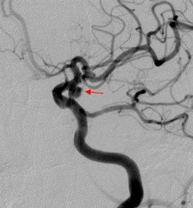 レントゲン写真：脳動脈瘤のある脳血管の様子