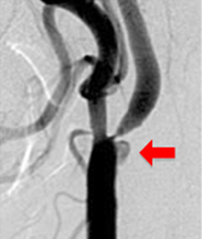 レントゲン写真：頸部頸動脈狭窄症