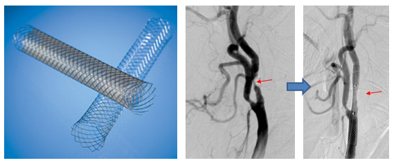 写真：頸動脈ステントと血管内治療