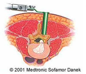 イラスト：腰椎椎間板ヘルニアに対する低侵襲椎間板摘出術