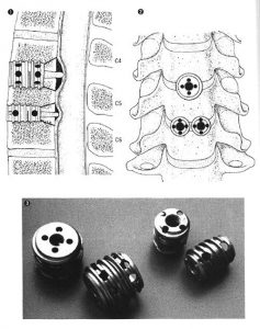 イラスト：頚椎症、頚椎椎間板ヘルニアに対する頚椎前方固定術