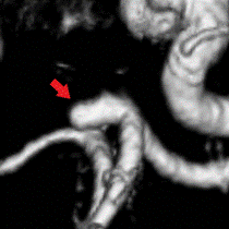 写真：手術前の脳動脈瘤