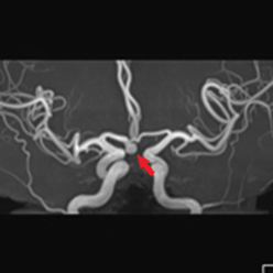 写真：未破裂脳動脈瘤、写真中央に動脈瘤が見られる