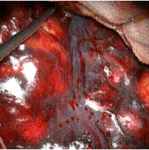 写真：クモ膜下出血の脳表