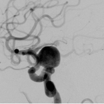 写真：手術前の脳動脈瘤
