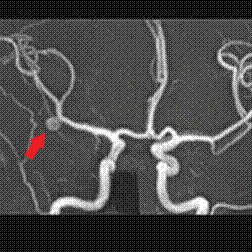 写真：脳動脈瘤の様子、写真左側の血管の分岐部付近に動脈瘤が見られる