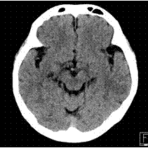 CT写真：正常の頭部