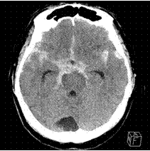 CT写真：クモ膜下出血の頭部