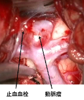 写真：血栓の様子、写真左側に止血血栓、右側に動脈瘤がある