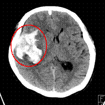 写真：クモ膜下出血、写真左側に脳出血が見られる