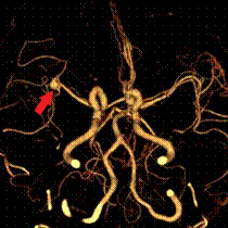 写真：脳動脈瘤、写真左側の血管分岐部付近に動脈瘤が見られる