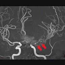 レントゲン写真：脳血管攣縮が見られる血管の様子