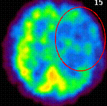 サーモグラフィ写真：脳血管攣縮により写真右上の血流が低下している様子