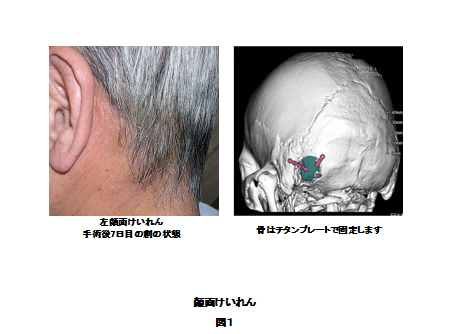 図1：左顔面けいれんの手術後7日目の創の状態の写真と骨をチタンプレートで固定するイラストイメージ