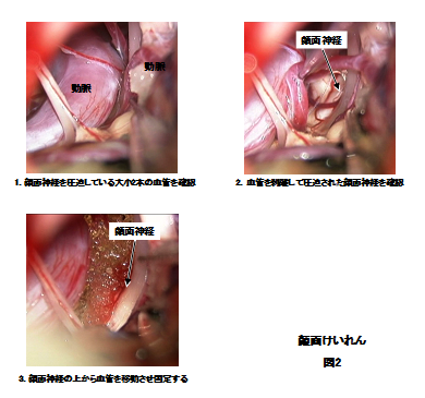 図1：顔面けいれんの手術手順を示した写真