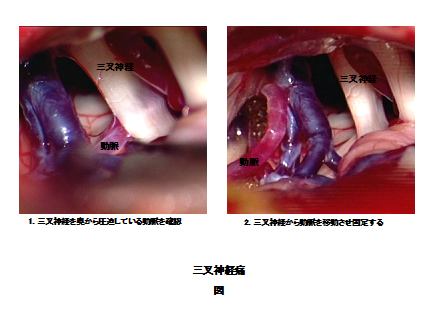 図：三叉神経痛の治療写真