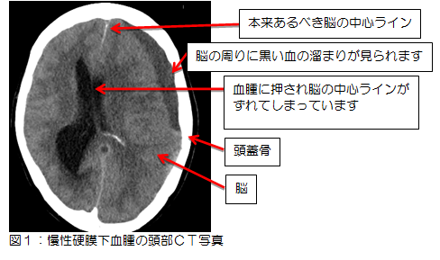 図1：慢性硬膜下血腫の頭部CT写真