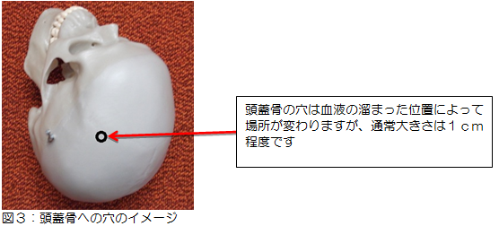 図3：頭蓋骨への穴のイメージ写真