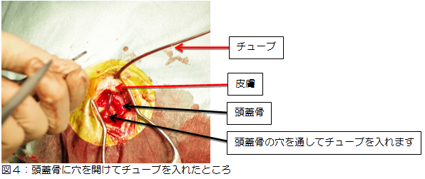 図4：頭蓋骨に穴を開けてチューブを入れた様子の写真