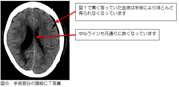 図6：手術翌日の頭部CT写真