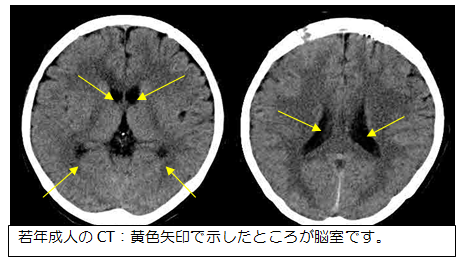 CT写真：脳室の様子