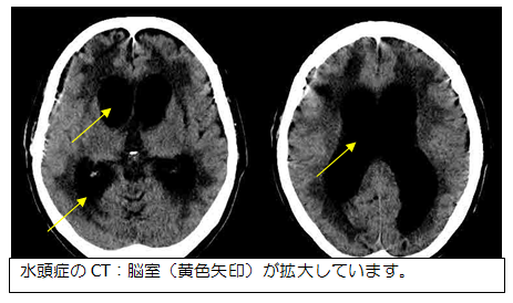 CT写真：水頭症の脳室の様子