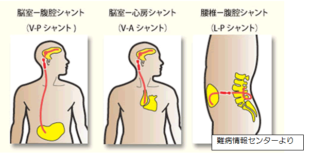 イラスト：シャント手術の比較