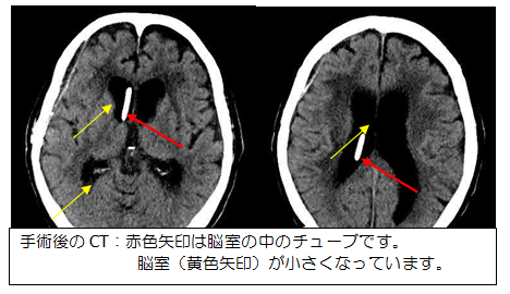 CT写真：手術後の様子