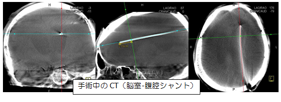 CT写真：脳室・腹腔シャントの手術中の様子