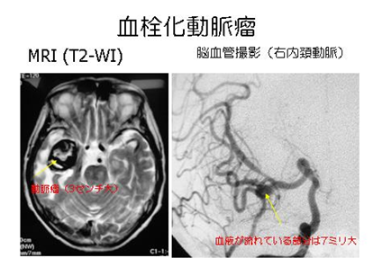 血栓化動脈瘤のMRI画像と脳血管撮影画像