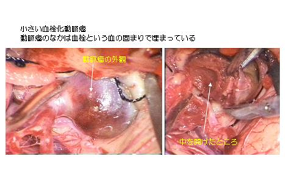 血栓化動脈瘤の外観と中を開いた写真