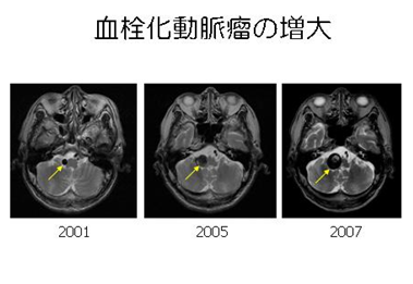 写真：血栓化動脈瘤が経年により増大する様子