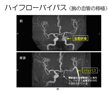 写真：ハイフローバイパス（腕の血管の移植の例）