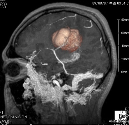 海綿状血腫の写真1