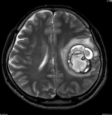 海綿状血腫の写真2