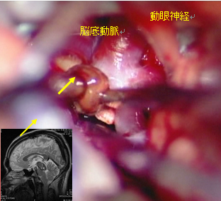 海綿血管腫摘出の写真1