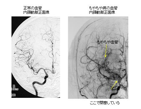 写真：正常の血管ともやもや血管の比較