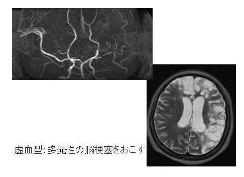 写真：もやもや血管の様子1、虚血型、多発性の脳梗塞をおこす