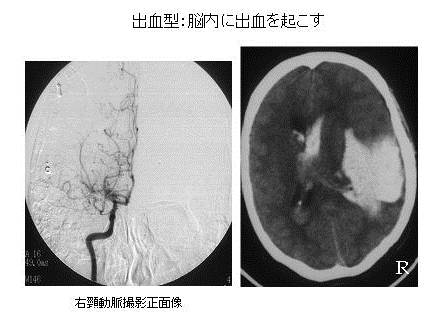 写真：もやもや血管の様子1、出血型、脳内に出血をおこす