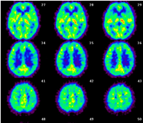 写真：脳血流PET検査（安静時）