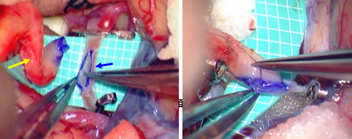 写真：中大脳動脈を切開している様子