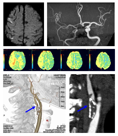 症候群性右頸動脈狭窄症の写真