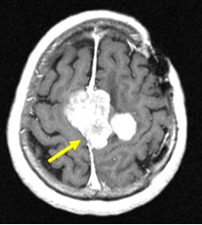 写真：トラクトグラフィー1、画像中央に脳腫瘍がある