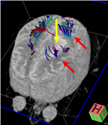 写真：トラクトグラフィー2、運動神経の位置が強調して示されている